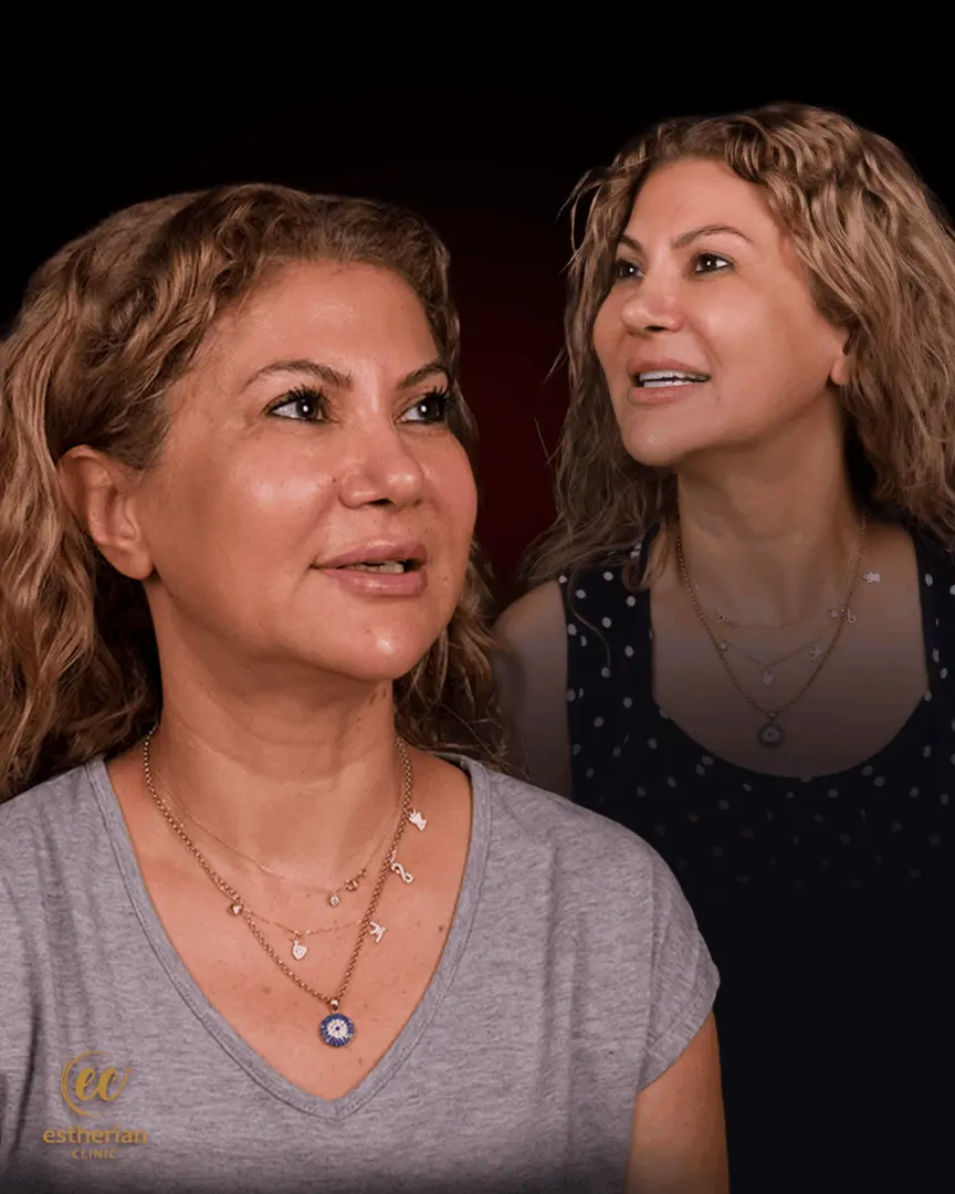 Hollywood Smile Results by the Estherian Clinic