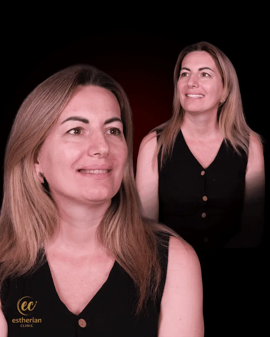 Hollywood Smile Transformation by the Estherian Clinic