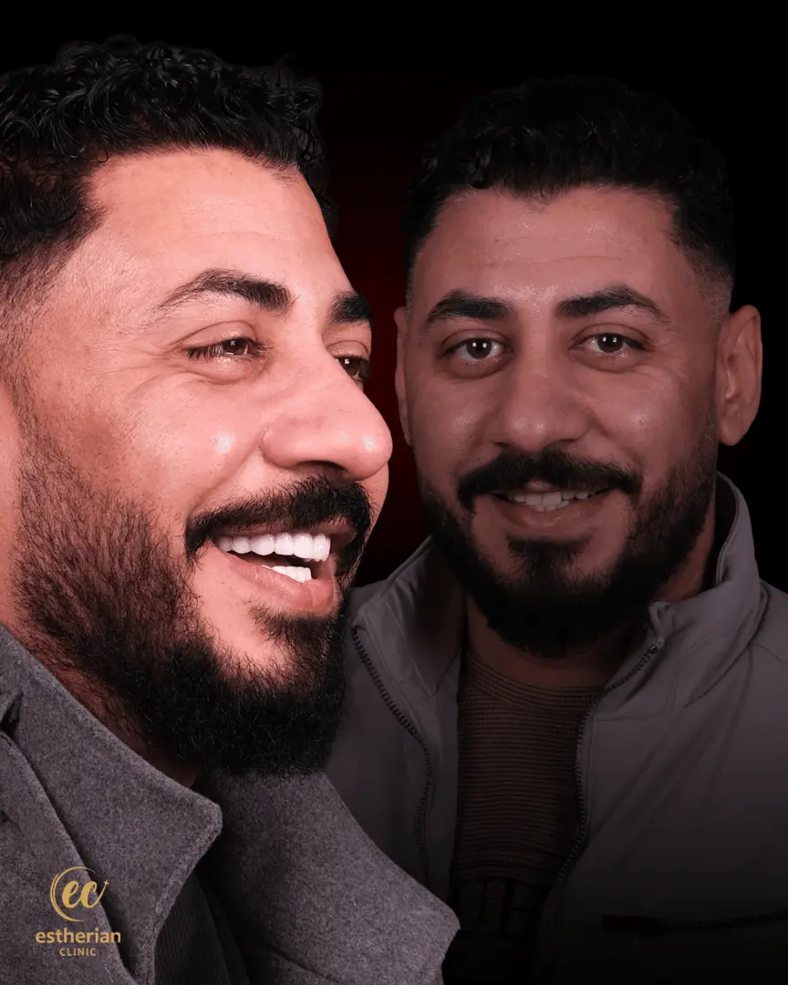 Hollywood Smile Transformation by the Estherian Clinic (Before and After)