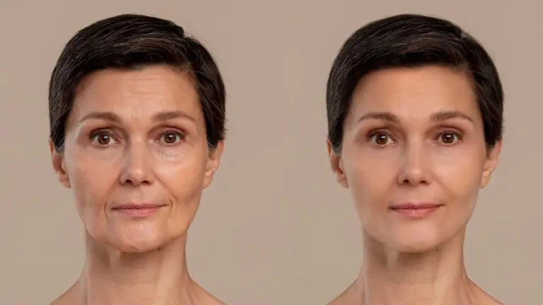 SMAS Facelift