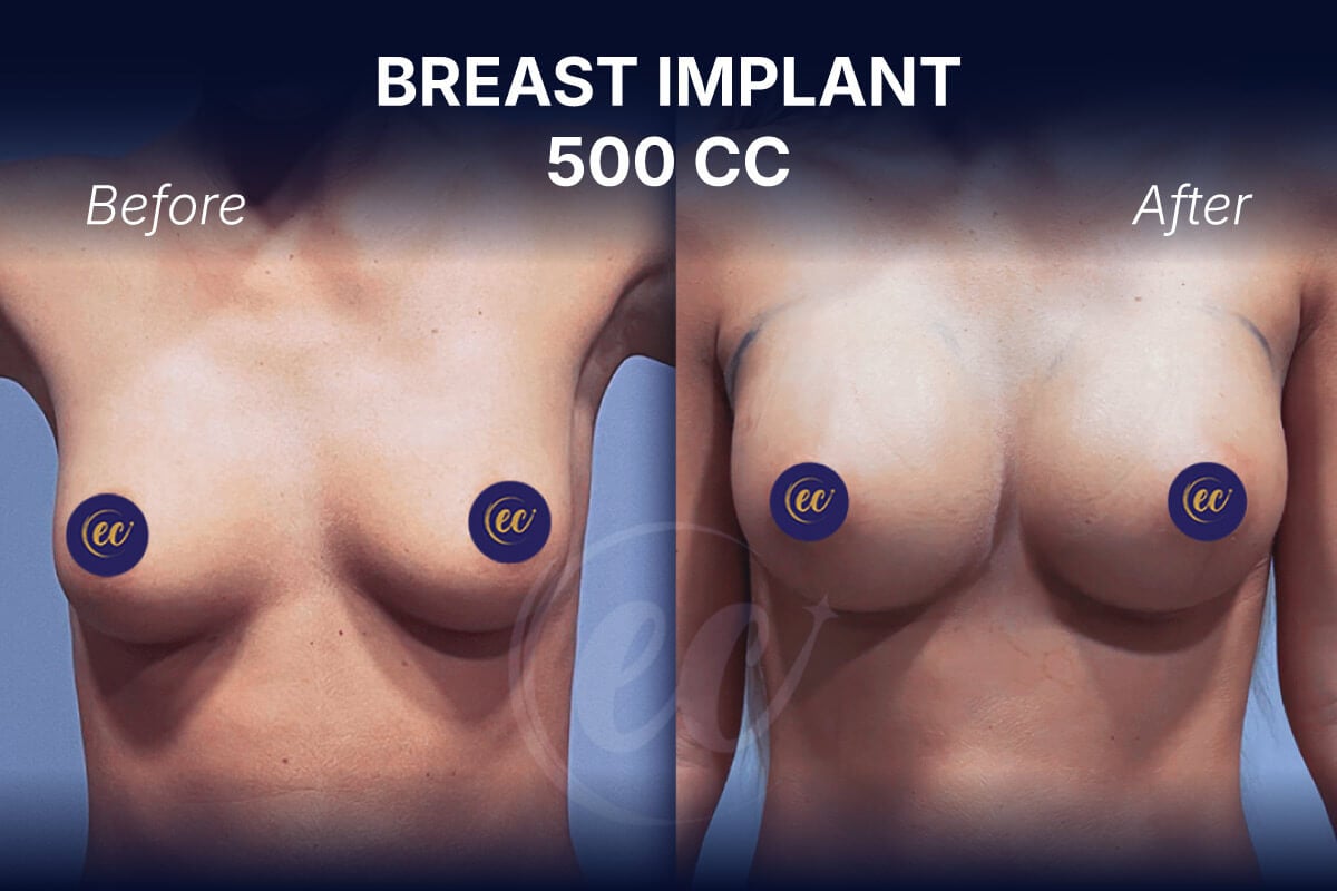 before-and-after image of 500 cc breast augmentation