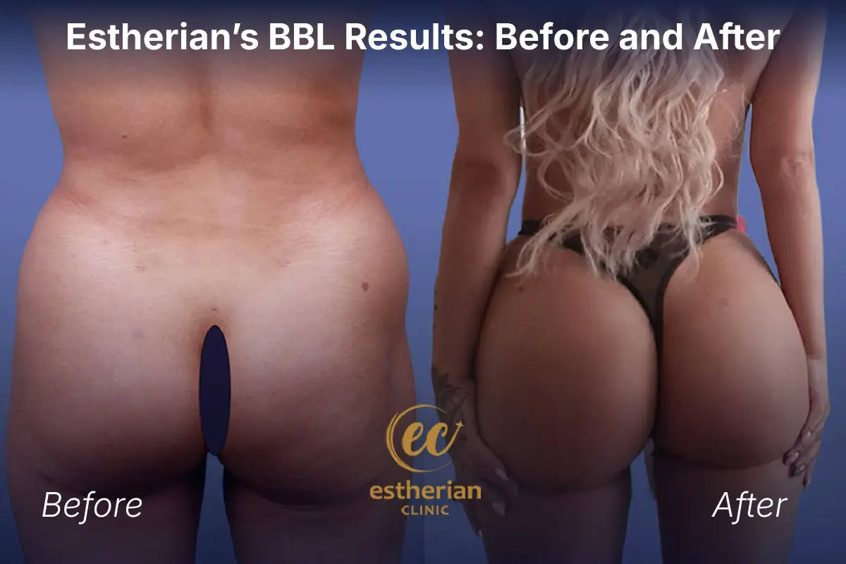 Estherian Clini's BBL results: Before and After