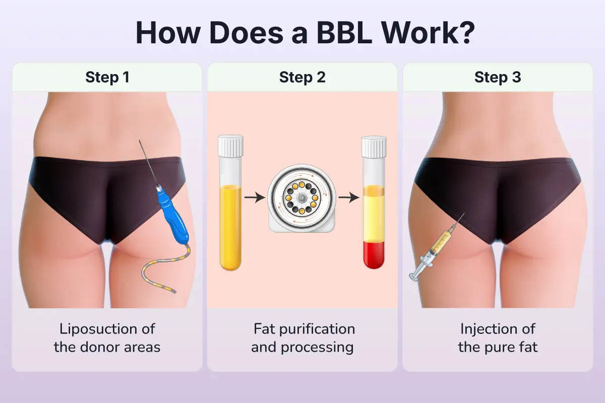 3 steps of BBL surgery