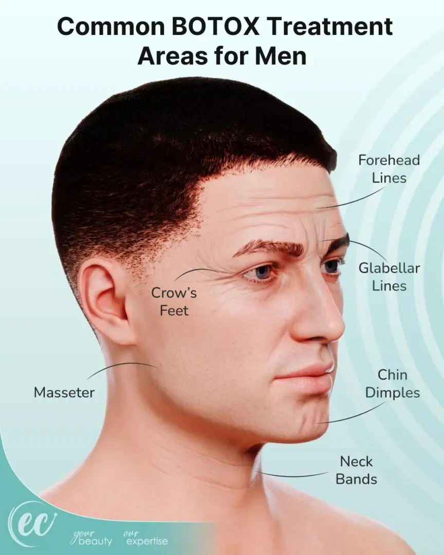 Common botox treatment areas for men