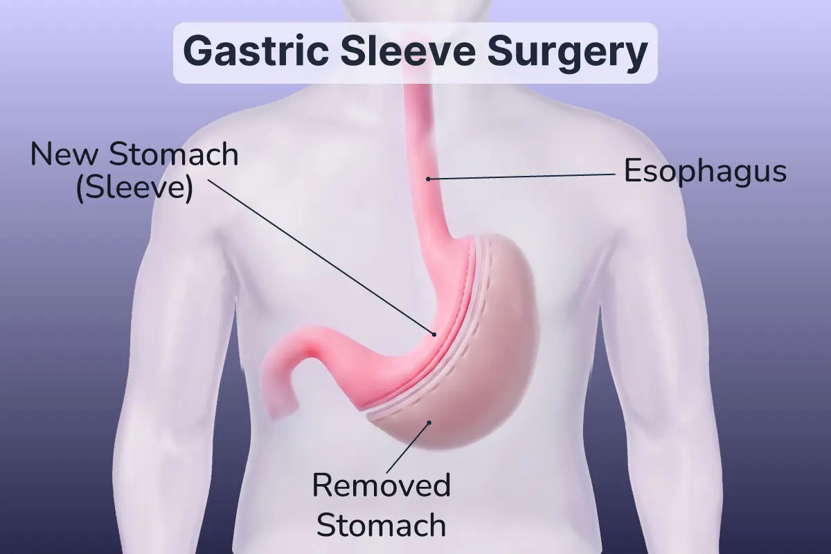 Gastric Sleeve Surgery Procedure