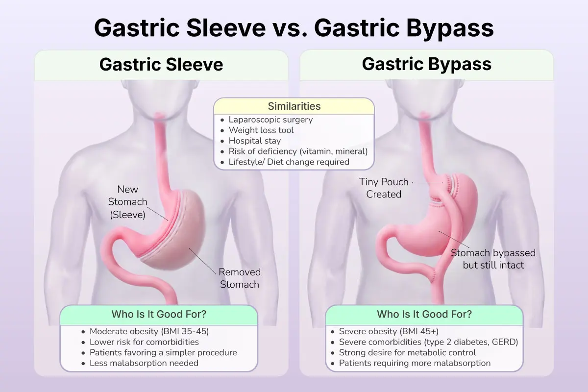 Gastric Bypass vs Sleeve
