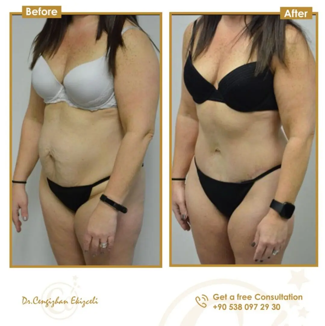 Tummy Tuck in Turkey at Estherian