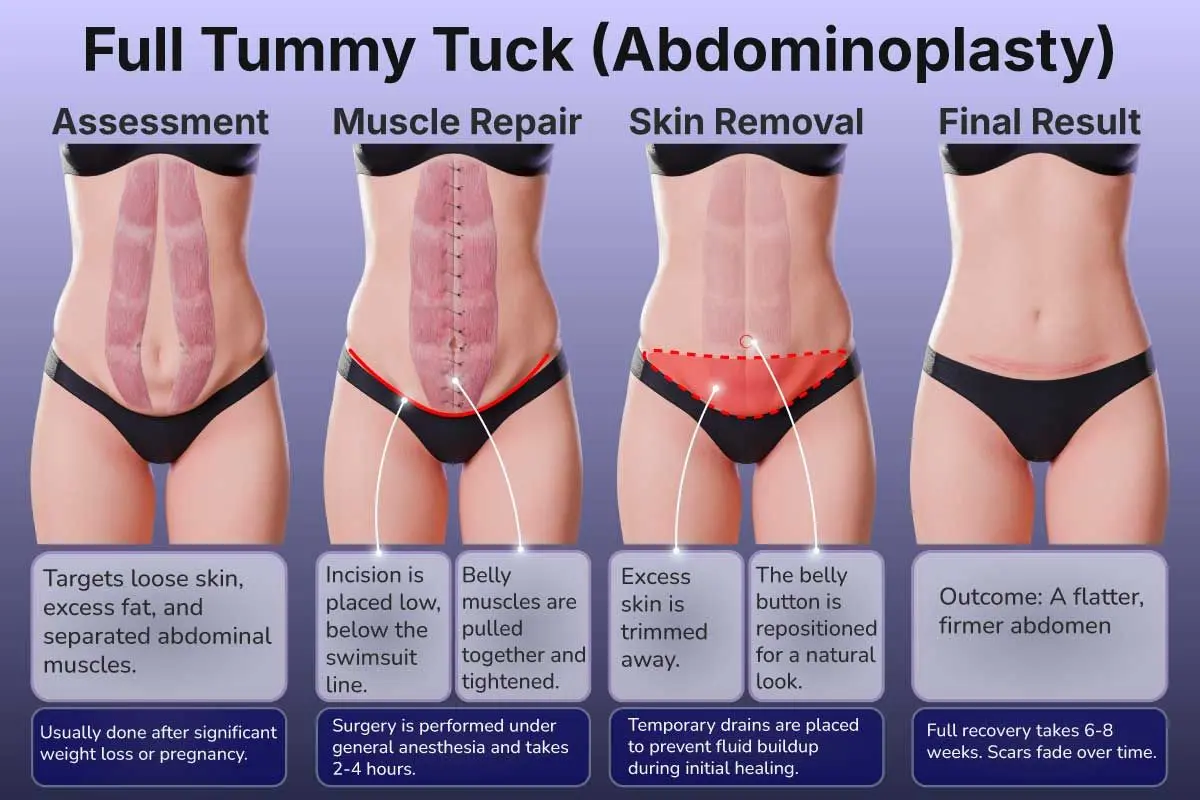 Tummy Tuck in Turkey (Abdominoplasty)