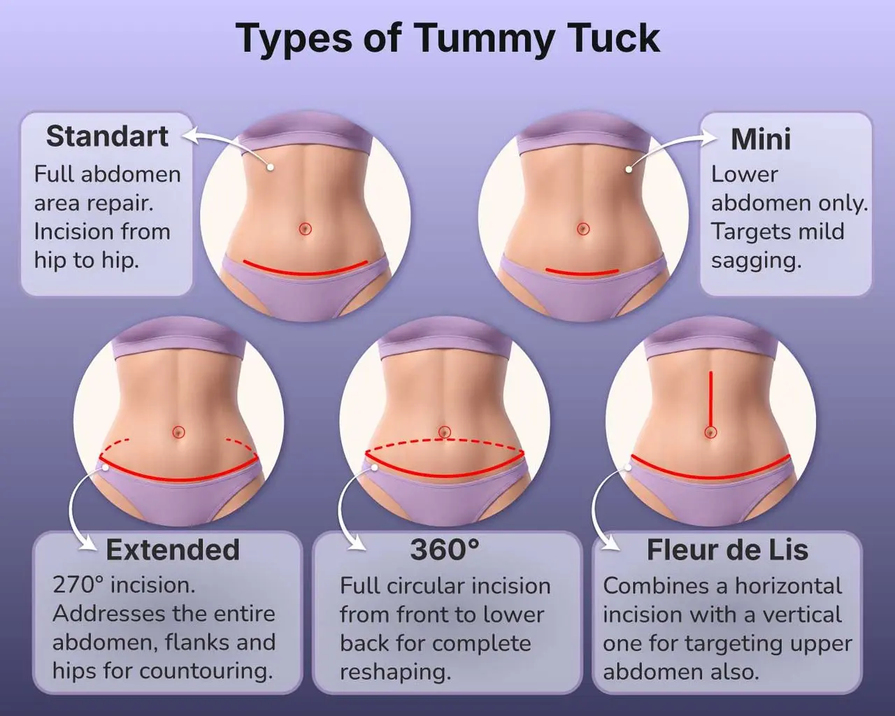 Types of Tummy Tuck in Turkey