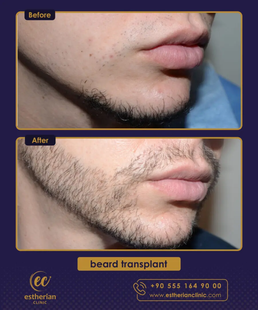 beard transplant before/after