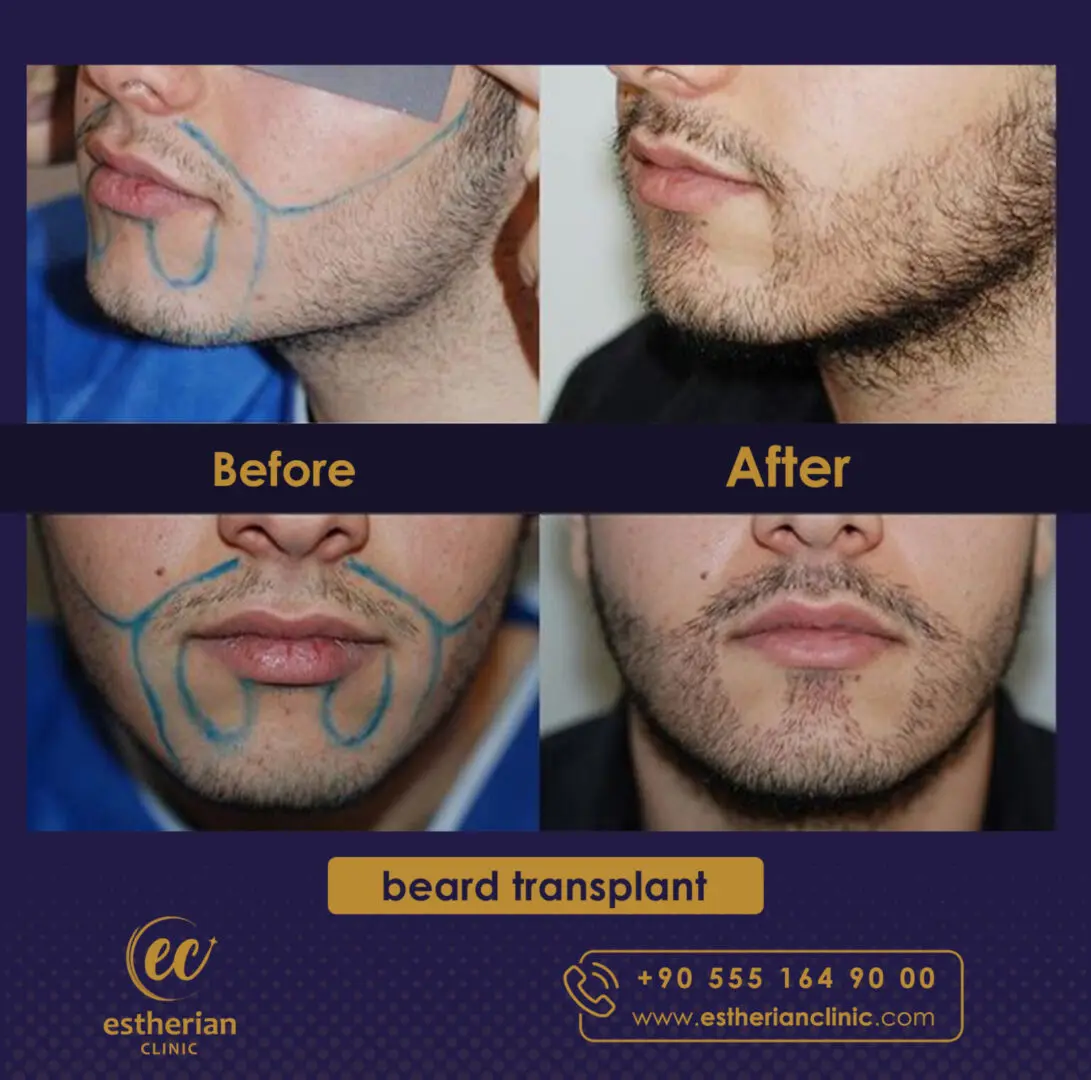 beard transplant before/after