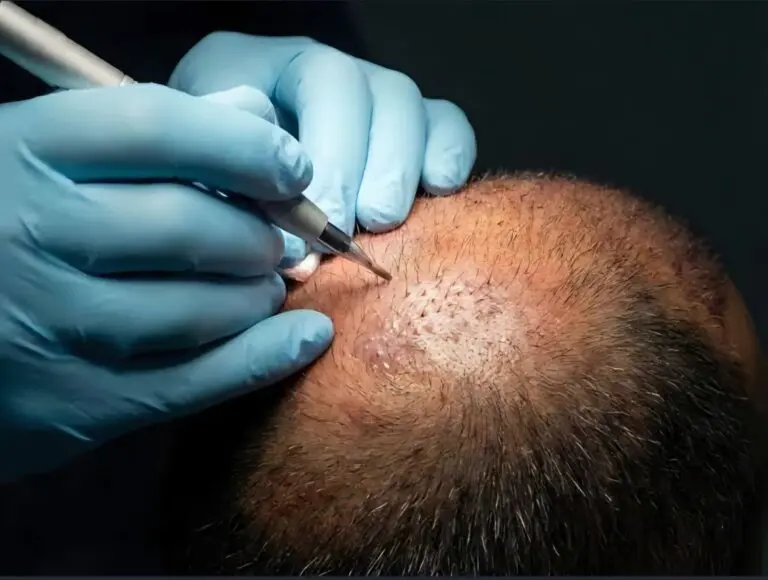 dhi-hair-transplant