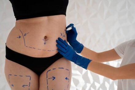 VASER Liposuction
