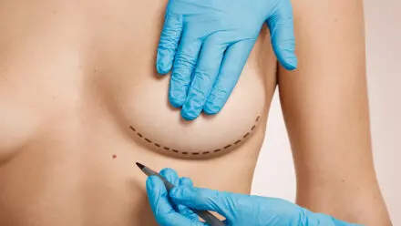 Breast Lift Without Implants