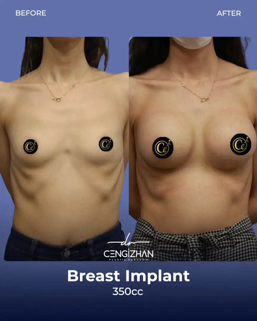 Breast Implant at Estherian Clinic