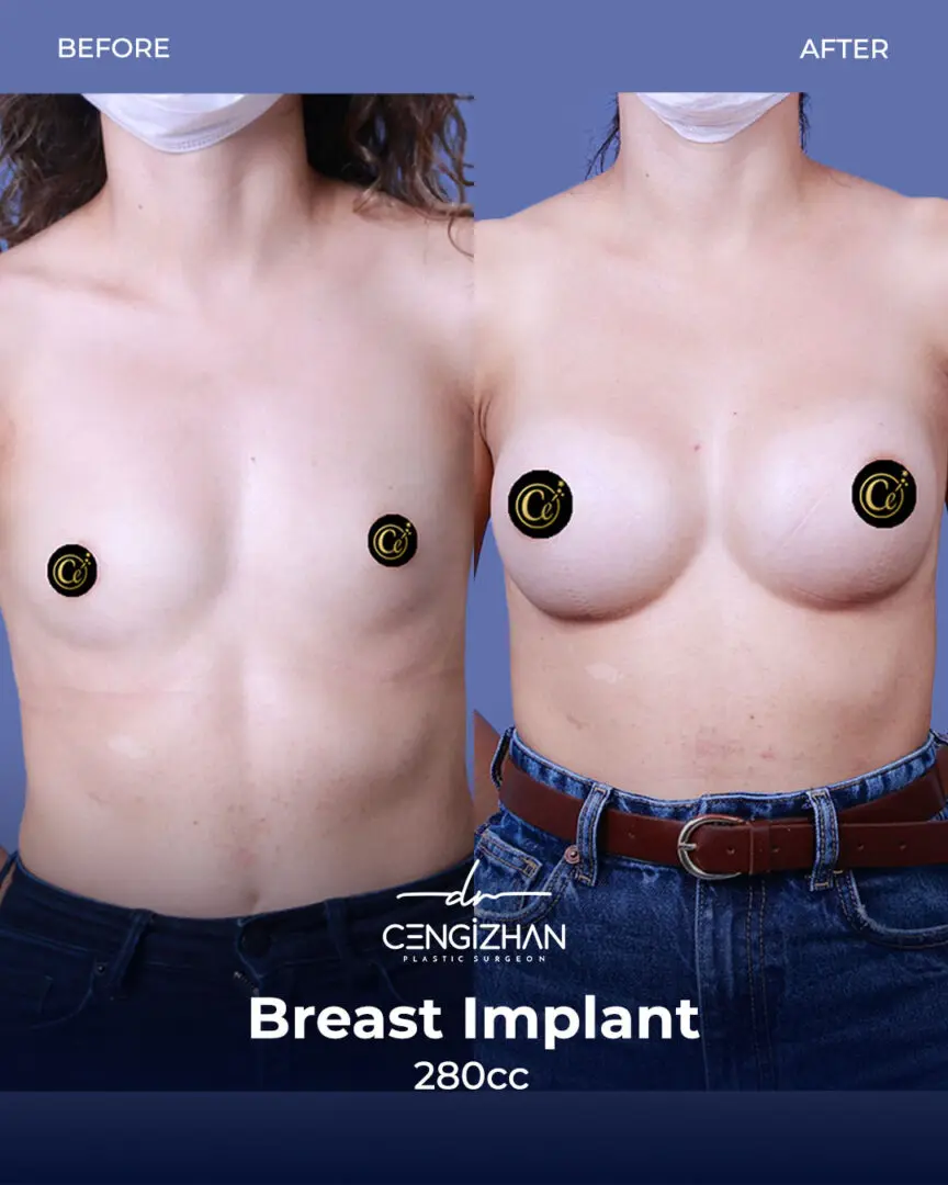 Estherian Clinic Breast Implant