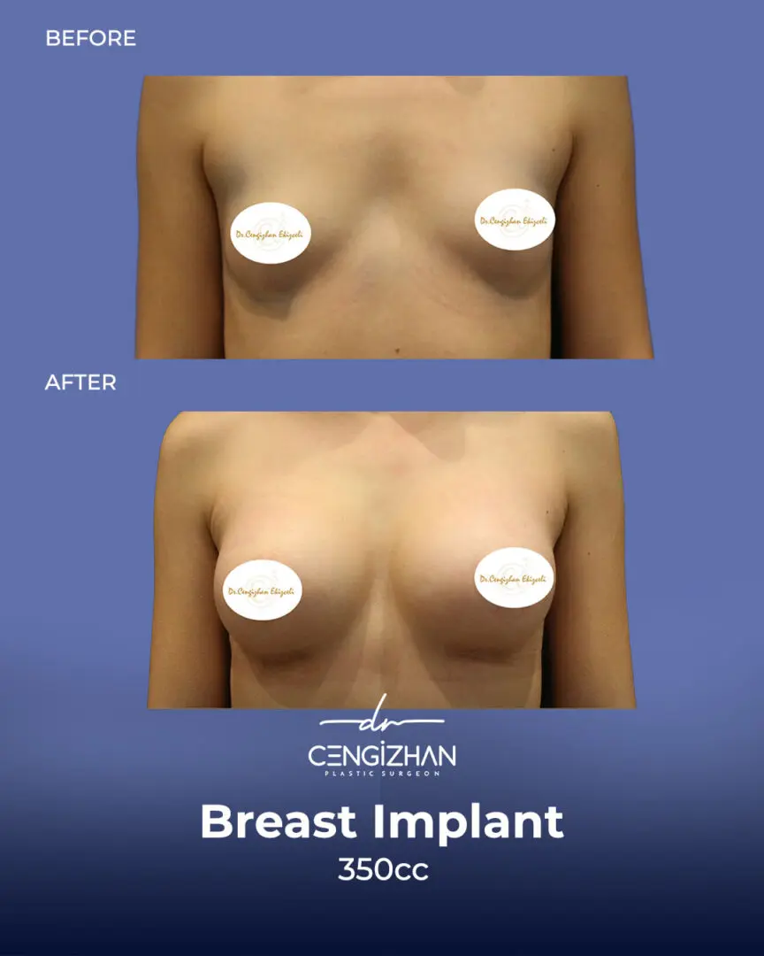 Breast-Implants at Estherian