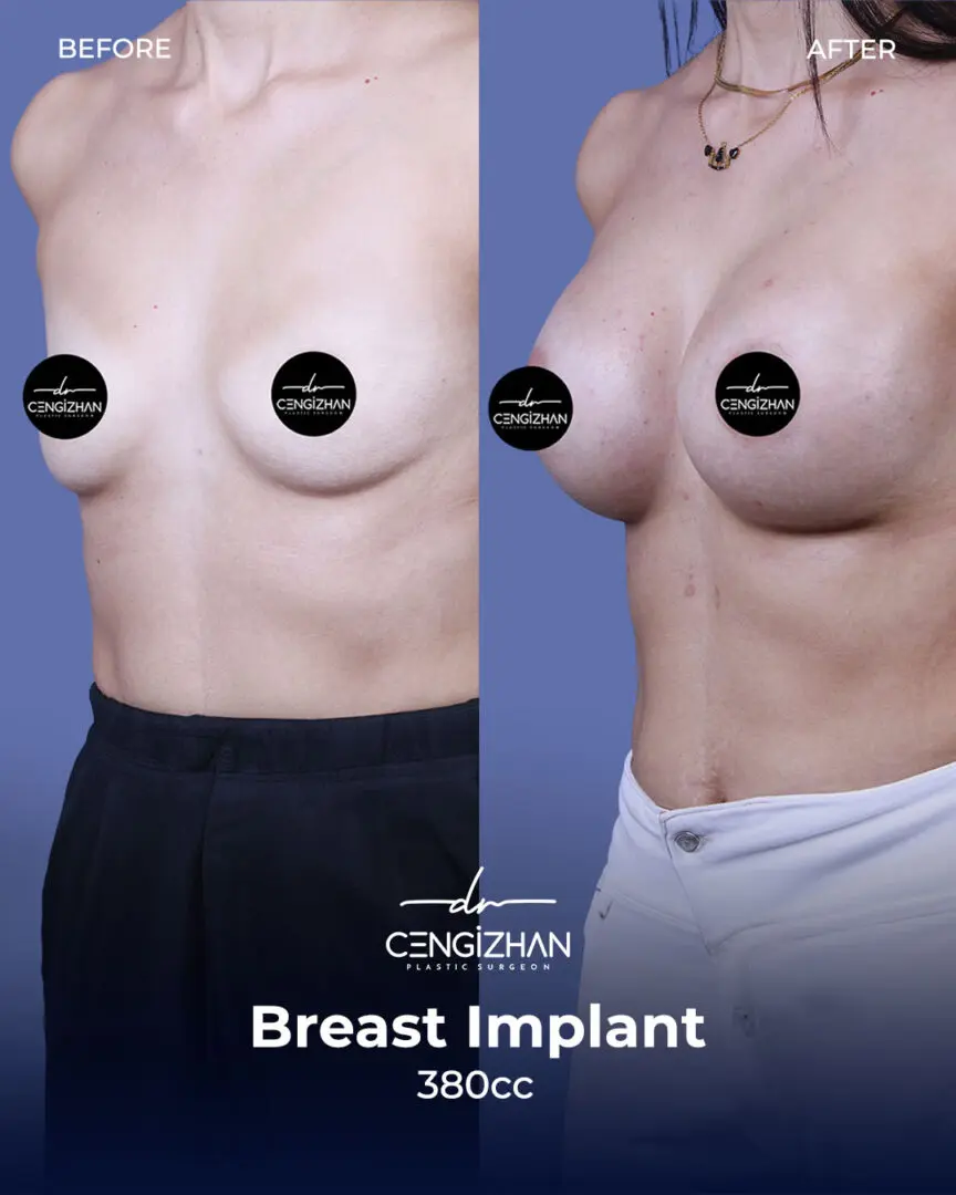 Estherian Breast Implant