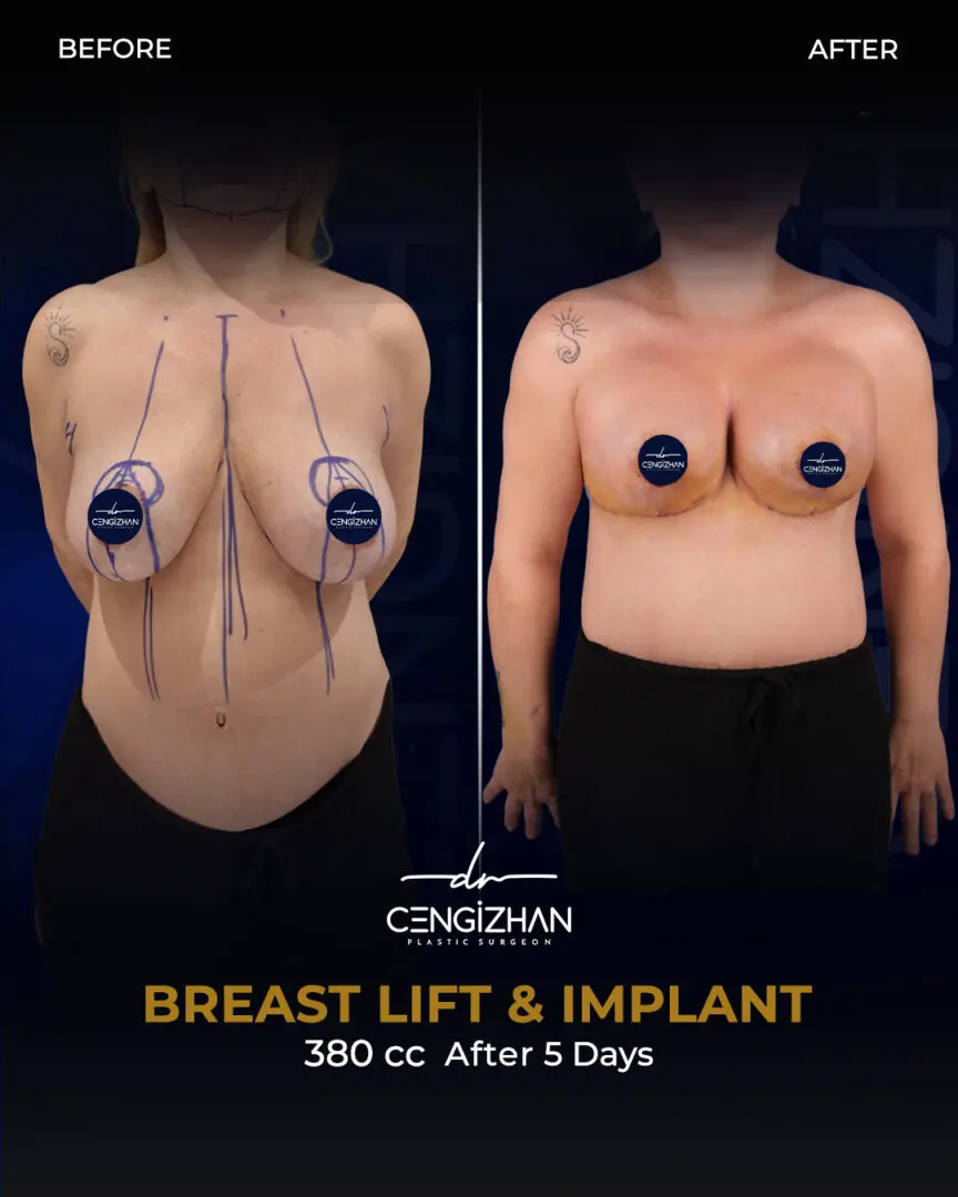 W-W-Breast Implant at Estherian Clinic