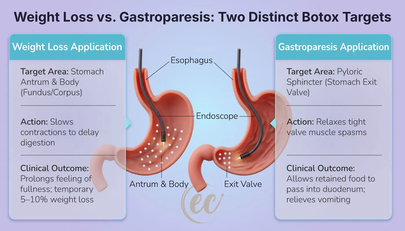 Anatomical comparison infographic contrasting Botox injections into the stomach body for weight loss versus the pylorus for gastroparesis.