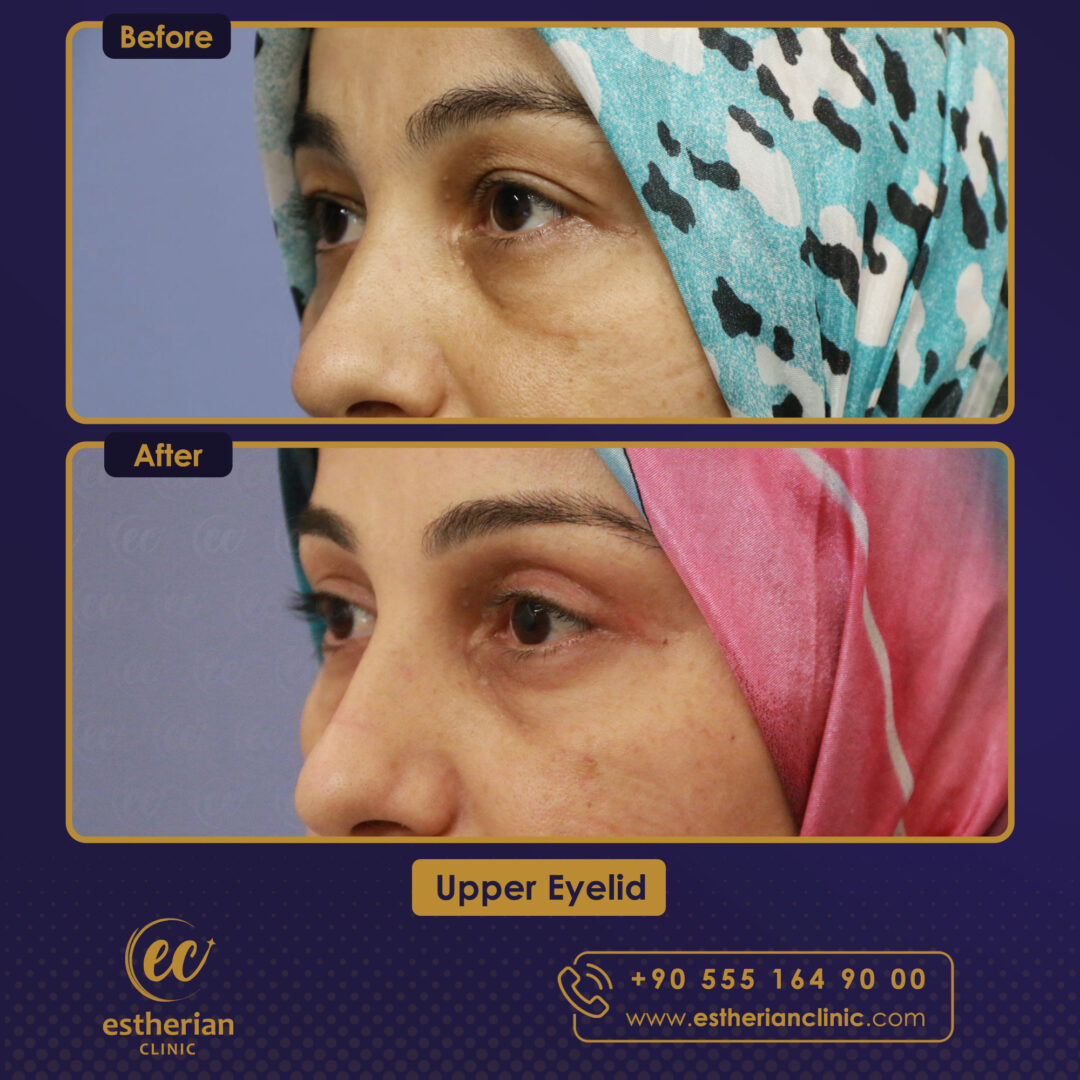 Blepharoplasty Eyelid Surgery In Turkey Estherian Clinic Blepharoplasty Eyelid Surgery In Turkey Estherian Clinic