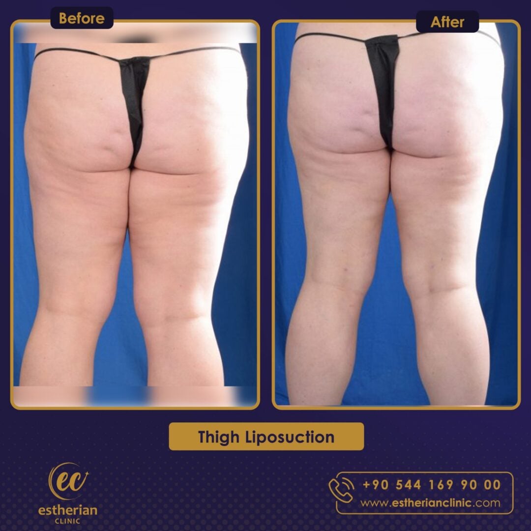 Liposcutanée des cuisses avant et après