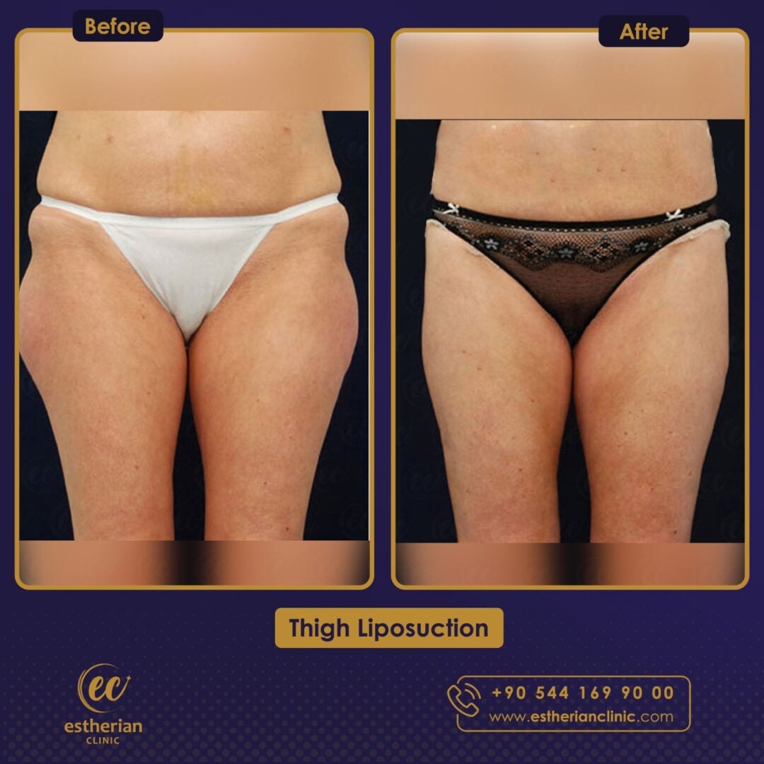 Liposuccion Avant - Après – Estherian Clinic