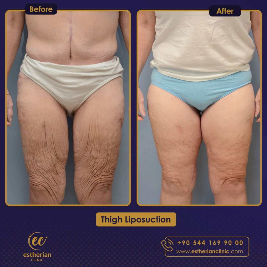Liposcutanée des cuisses avant et après