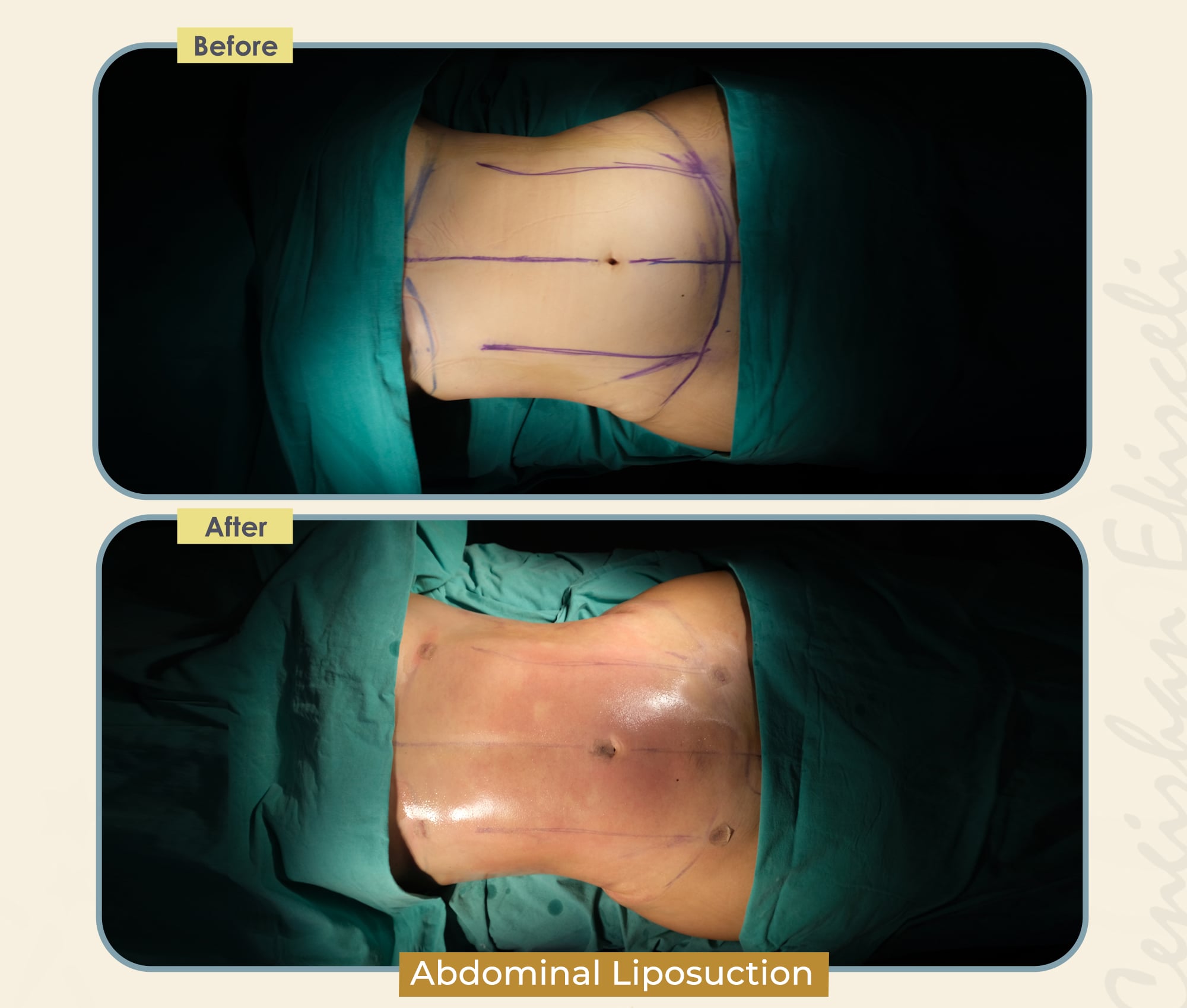 Abdominal Liposuction | Estherian Clinic