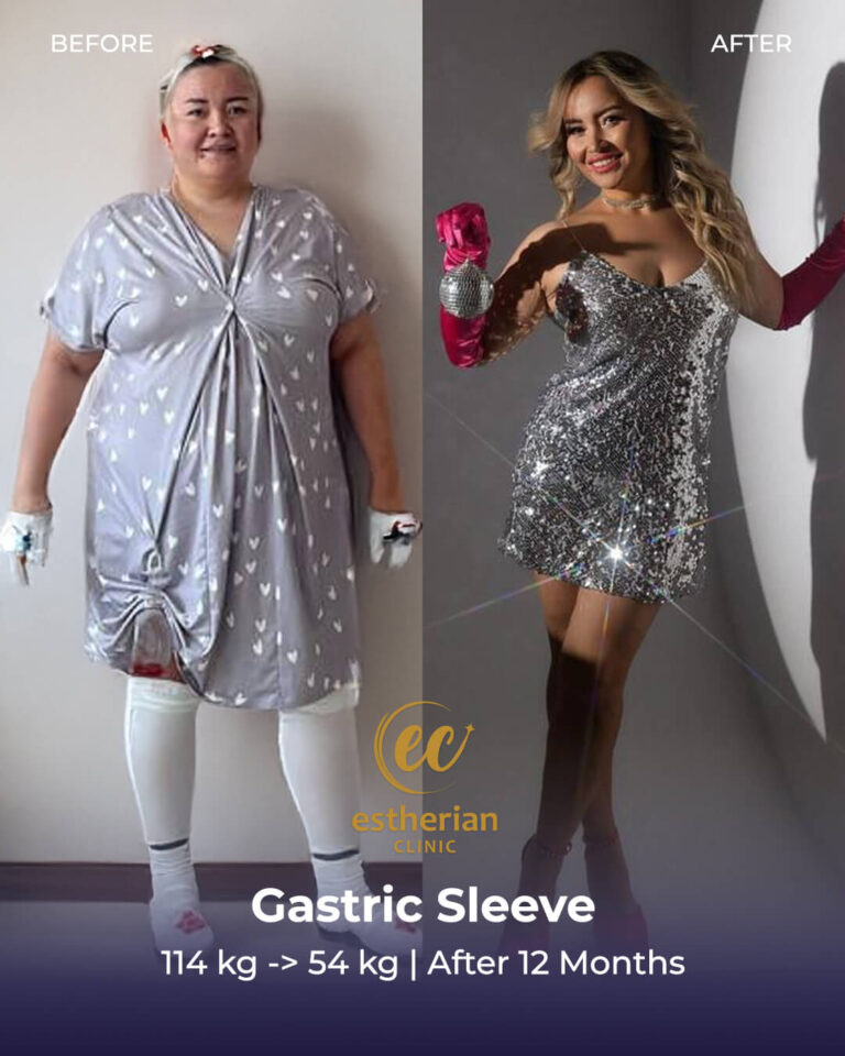 Gastric Sleeve Surgery in Turkey | Estherian Clinic