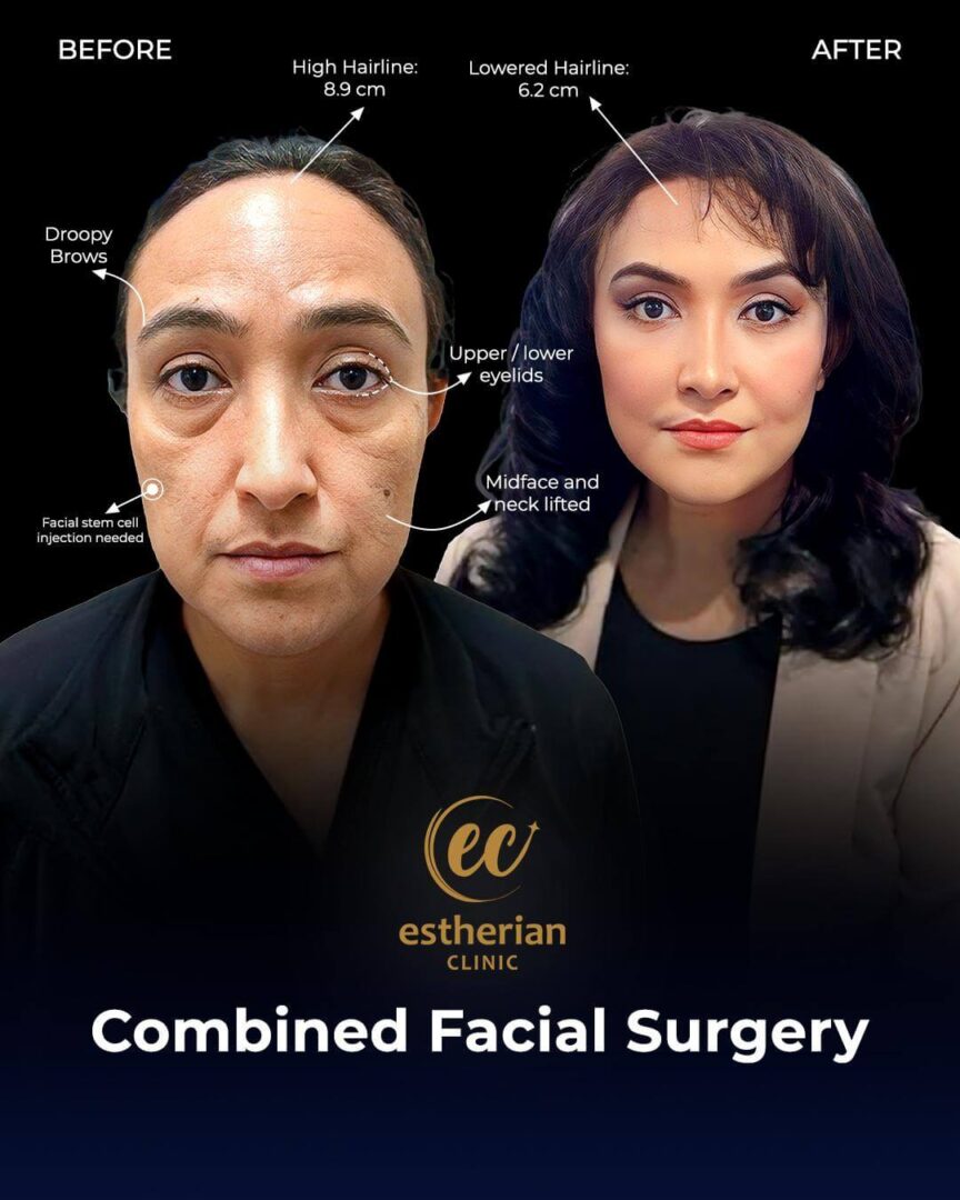 Combined Facial Surgery Before After
