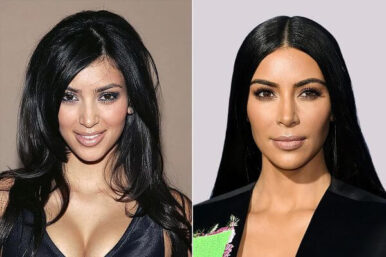 Kim Kardashian’s Cosmetic Surgeries and Differences | Estherian Clinic