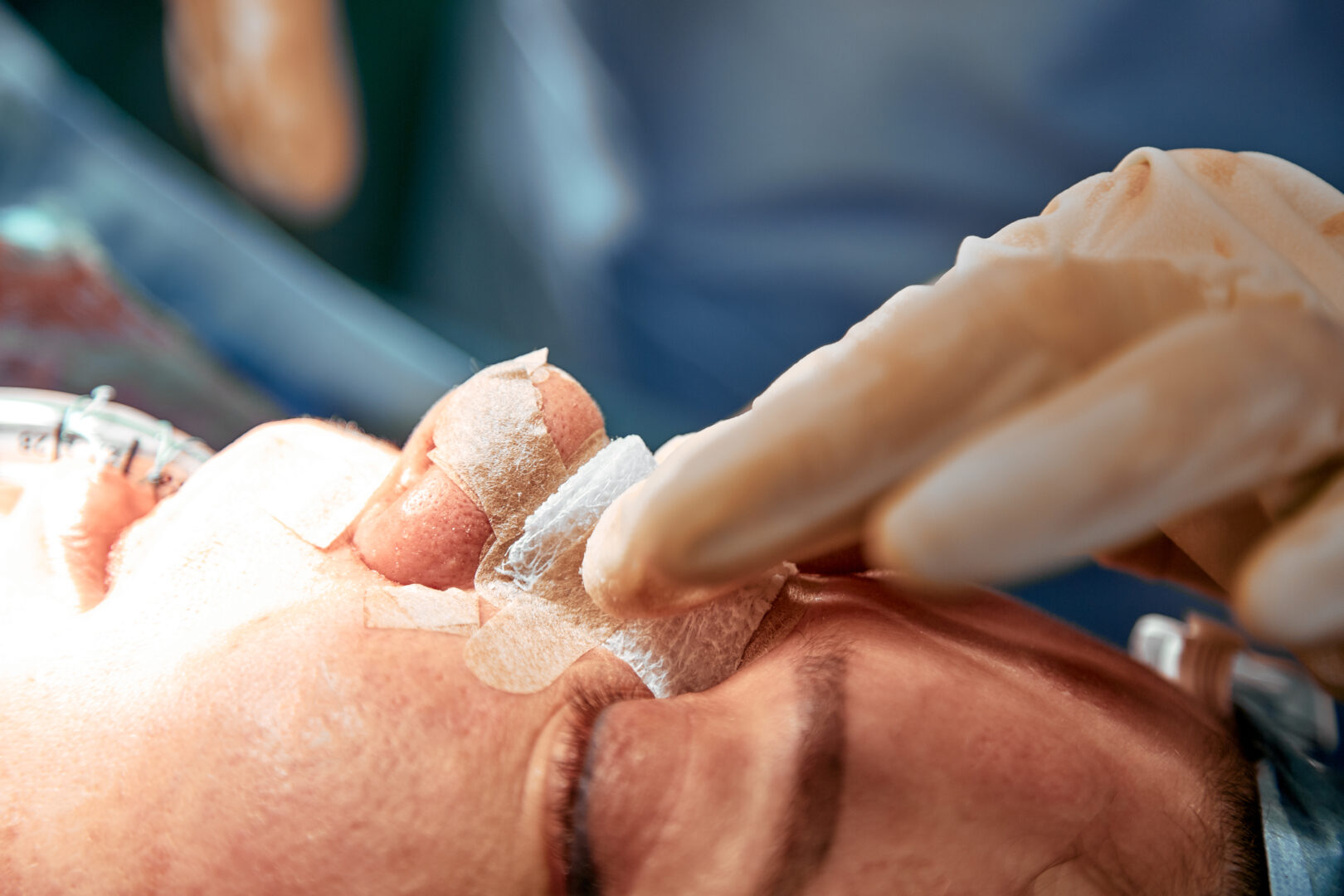 Post-Rhinoplasty Long-Term Results and Considerations